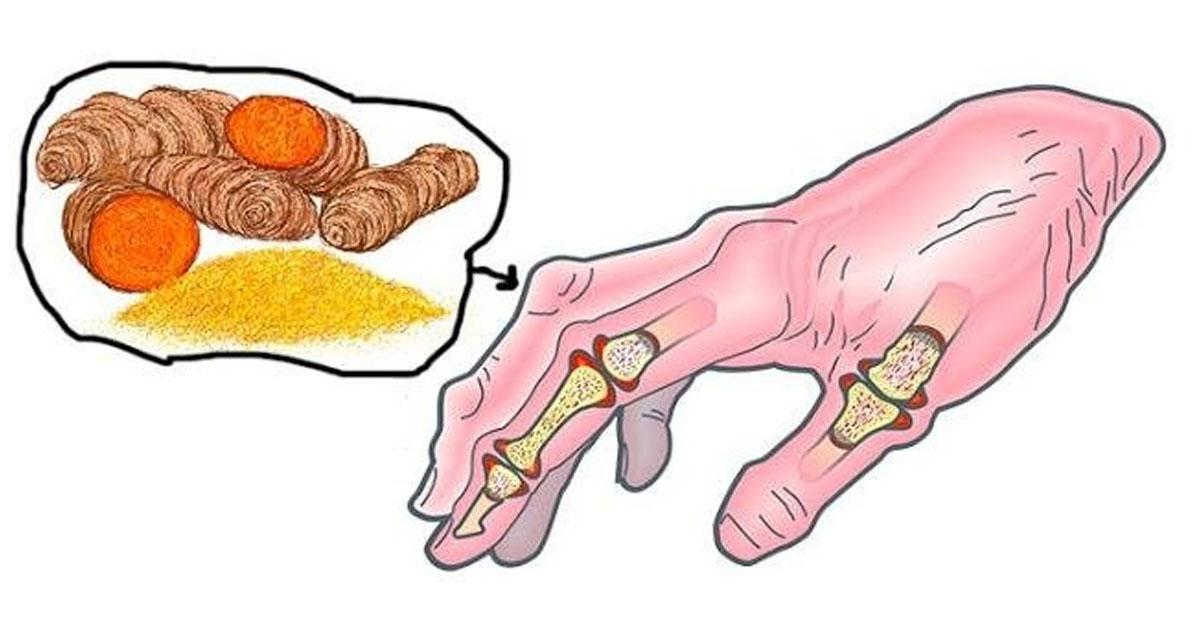 Alimentacion para artritis